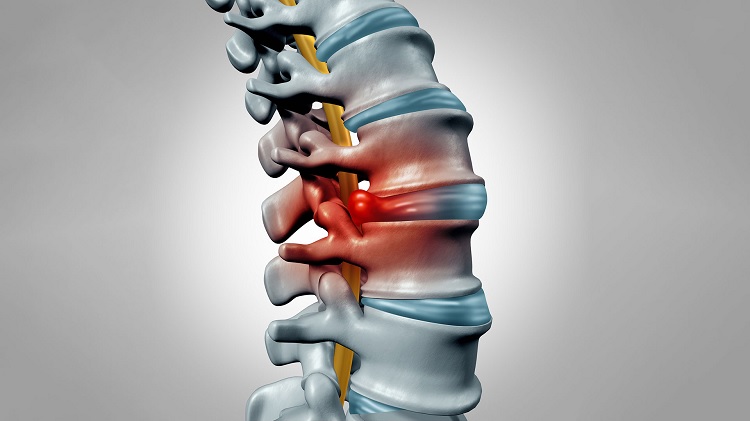 Pinzamiento lumbar