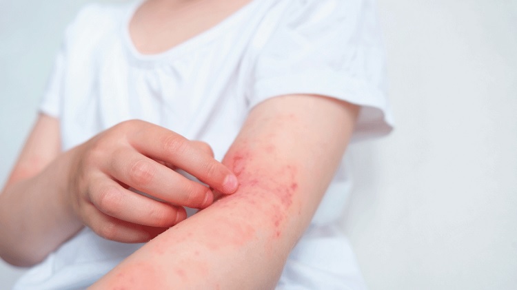 Alergias en la piel: tipos, síntomas y tratamiento