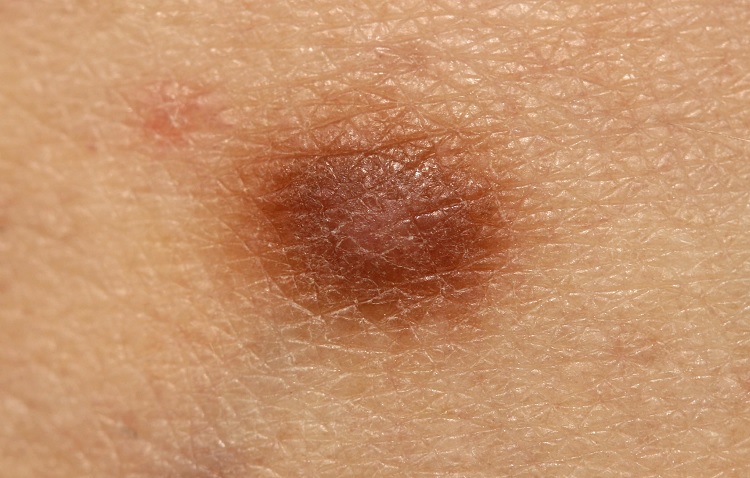 Dermatofibroma
