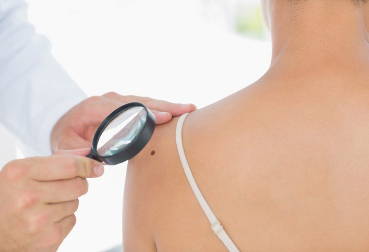 ¿Qué es un dermatofibroma y cómo eliminarlo?