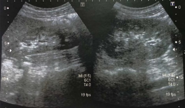 Ecografía abdominal: qué es y cuándo se realiza