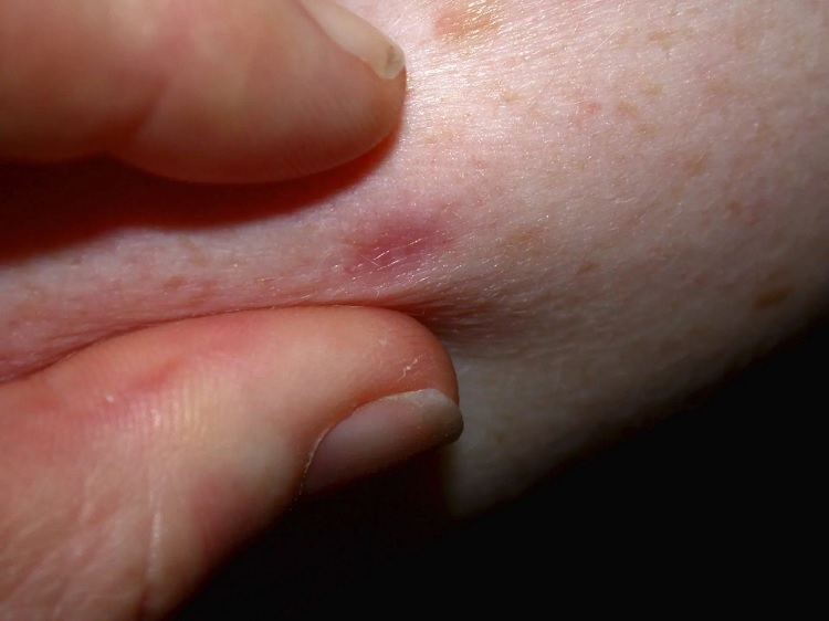 Diagnóstico del dermatofibroma