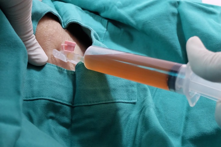¿Qué es un seroma y por qué aparece?