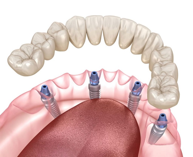 Implantes dentales