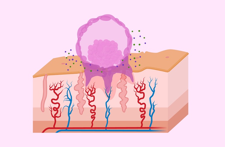Sangrado de implantación