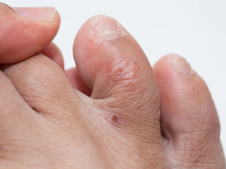 Dishidrosis