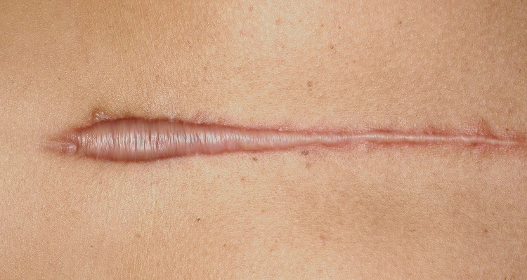 Queloide