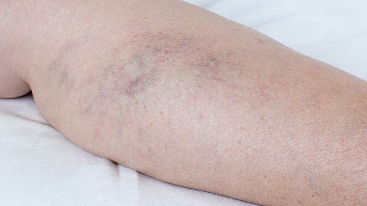 Riesgos de flebitis