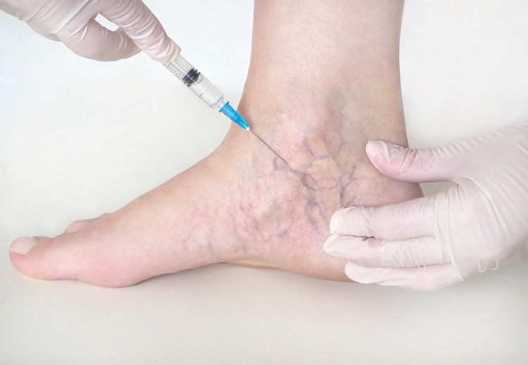 Tratamiento telangiectasia