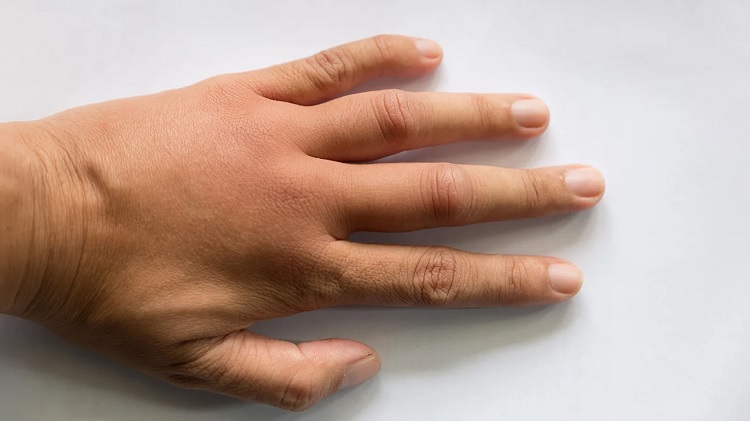 Bultos en los dedos de la mano