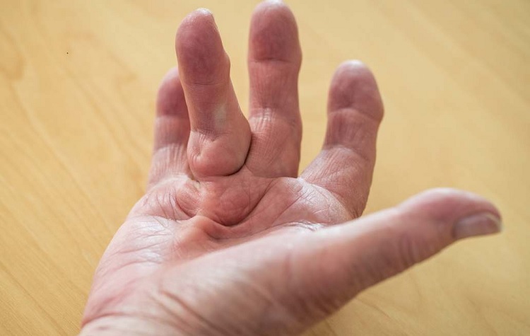 Causas de bultos en los dedos de la mano y tratamientos