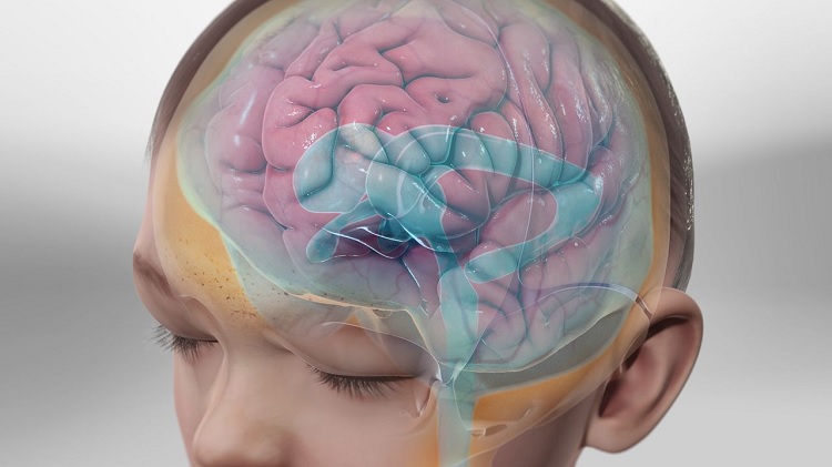 Hidrocefalia: qué es, causas y tratamiento