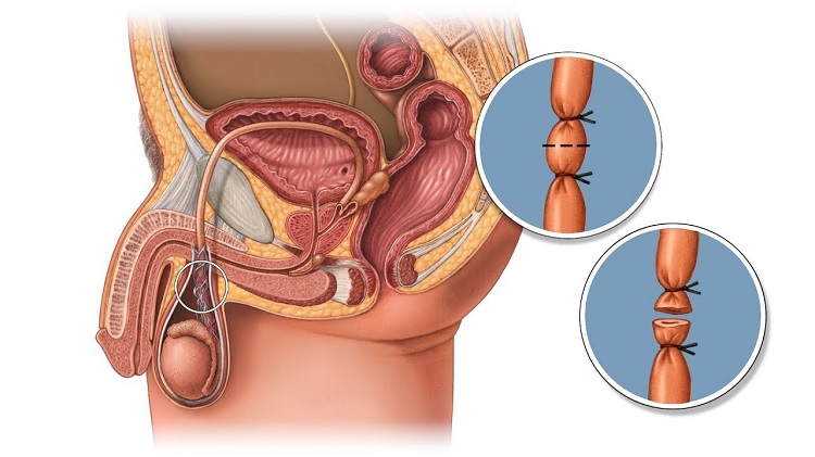 Vasectomía