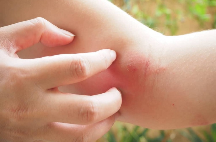 Complicaciones de picaduras