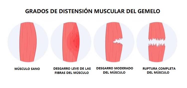 Tirón en el gemelo