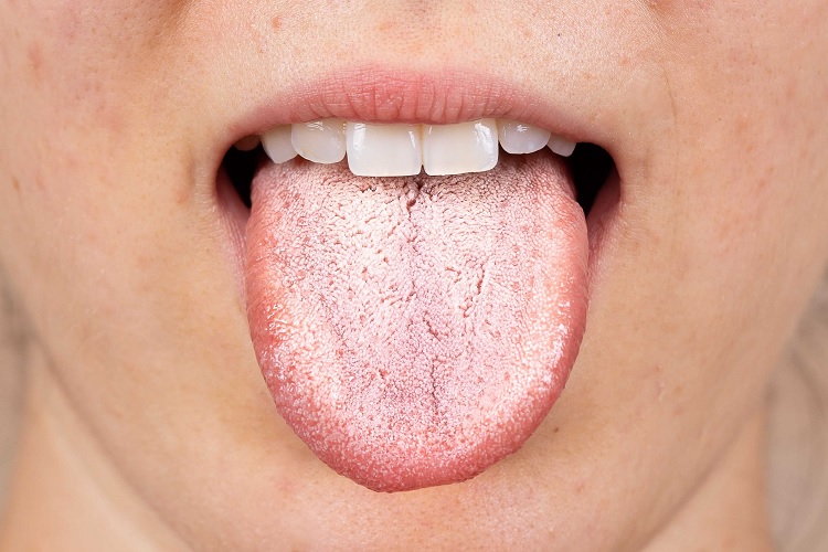 Lengua saburral: síntomas, causas y tratamiento