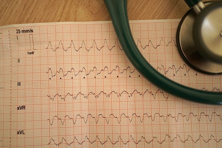 Taquicardia ventricular: qué es, causas y tratamiento