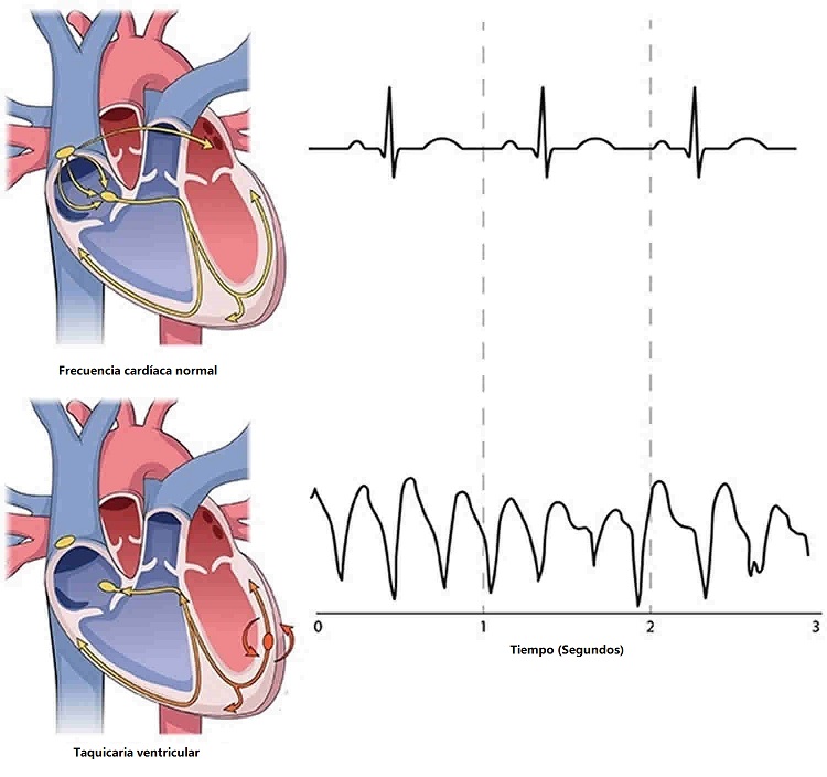 Taquicardia ventricular