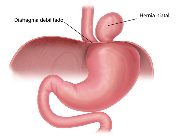 Hernia hiatal