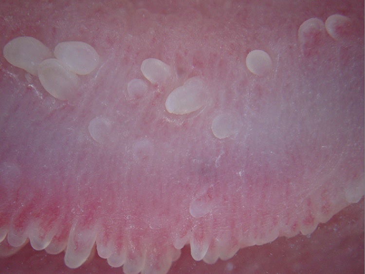 Pápulas perladas