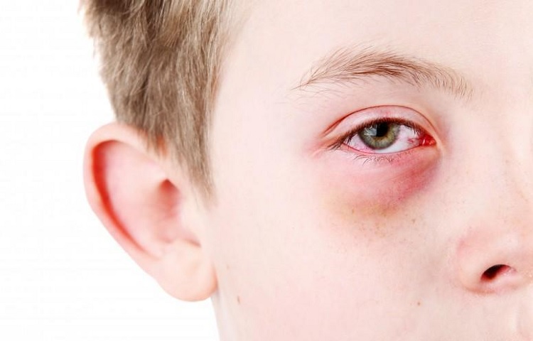 Conjuntivitis en niños: síntomas, causas y prevención