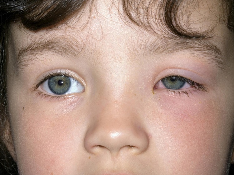 Conjuntivitis en niños