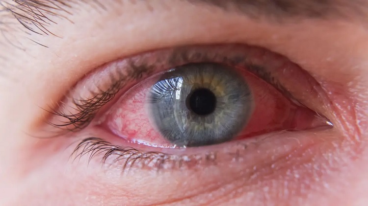 Conjuntivitis