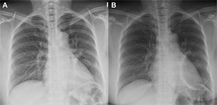 Diagnóstico hemoptisis
