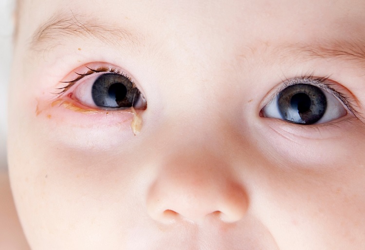 Síntomas de la conjuntivitis