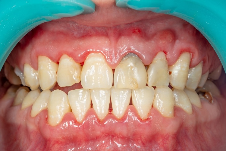 Causas de la enfermedad periodontal