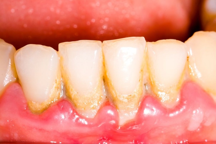 Causas de la gingivitis