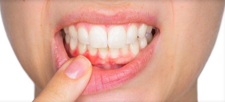 Enfermedad periodontal
