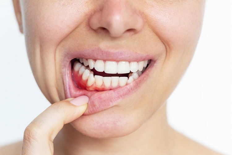 ¿Cuál es el mejor tratamiento para la gingivitis?