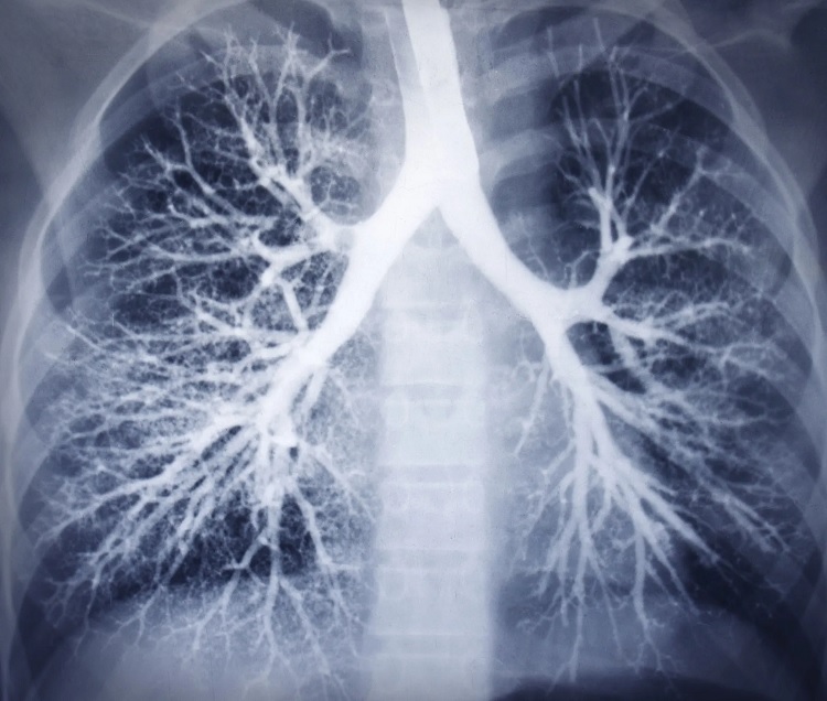 Pulmones
