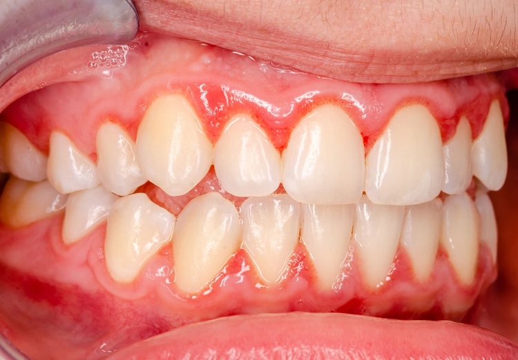 Tratamiento para la gingivitis