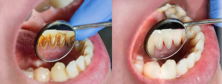 Tratamiento periodontal