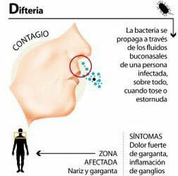 Causas de la difteria