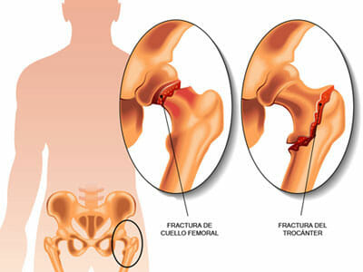 Diagnóstico de la fractura de cadera