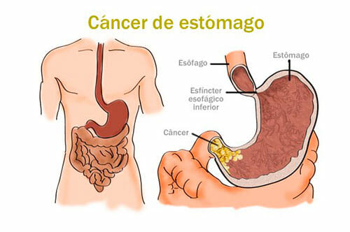 Causas y síntomas del cáncer de estómago