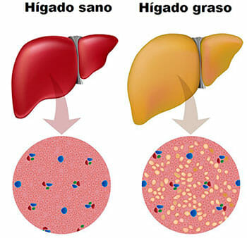 Causas del hígado graso