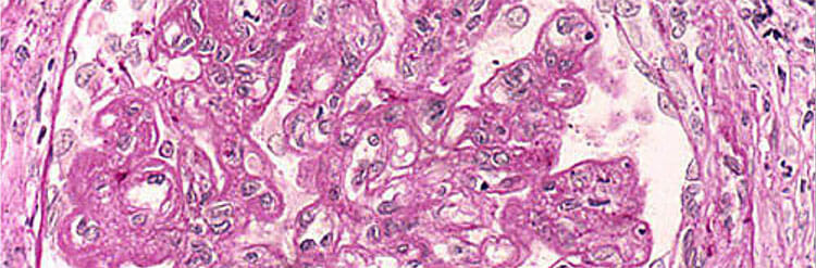 Biopsia renal para diagnosticar glomerulonefritis membranoproliferativ