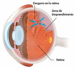 Causas del desprendimiento de retina