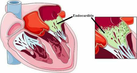 Causas de la endocarditis