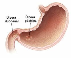 Causas de la úlcera duodenal