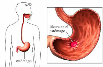 Causas de la úlcera gástrica