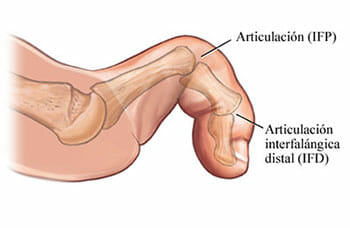 Diagnóstico de los dedos en garra