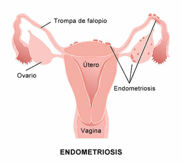 Causas de la endometriosis