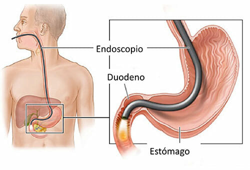 Endoscopia para diagnostica una hemorragia digestiva