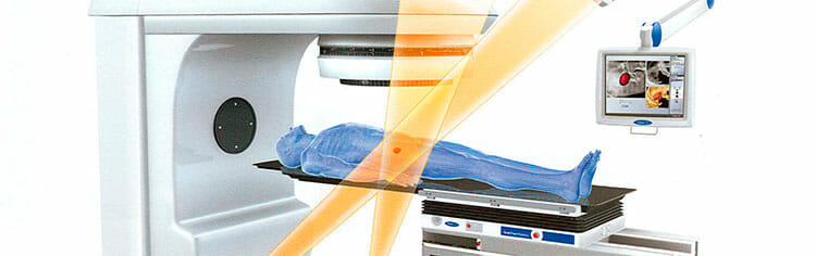 Cómo funciona la radioterapia