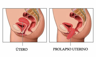 Causas del prolapso uterino